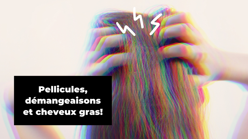 Mains qui grattent un cuir chevelu qui a des problèmes de pellicules, démangeaisons et cheveux gras