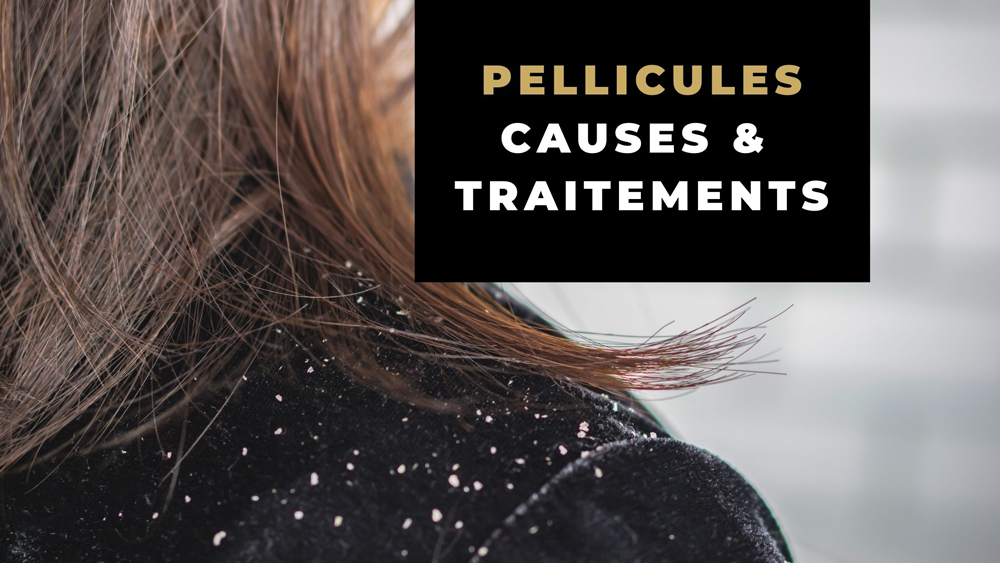 Pellicules sur les cheveux avec un accent sur leurs causes et traitements.