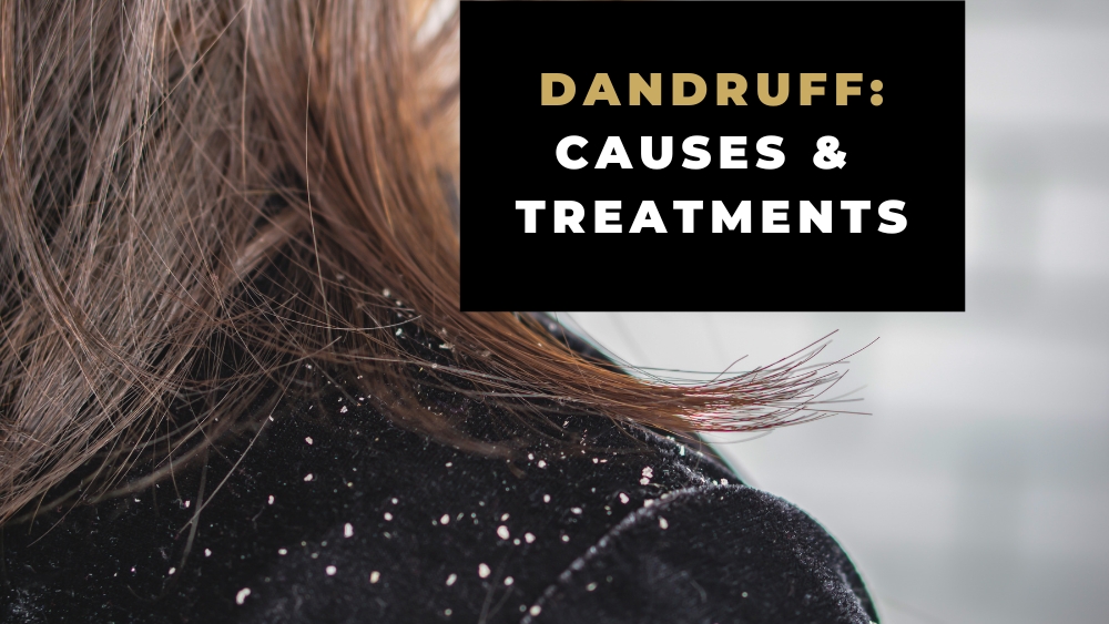 White dandruff on a shoulder